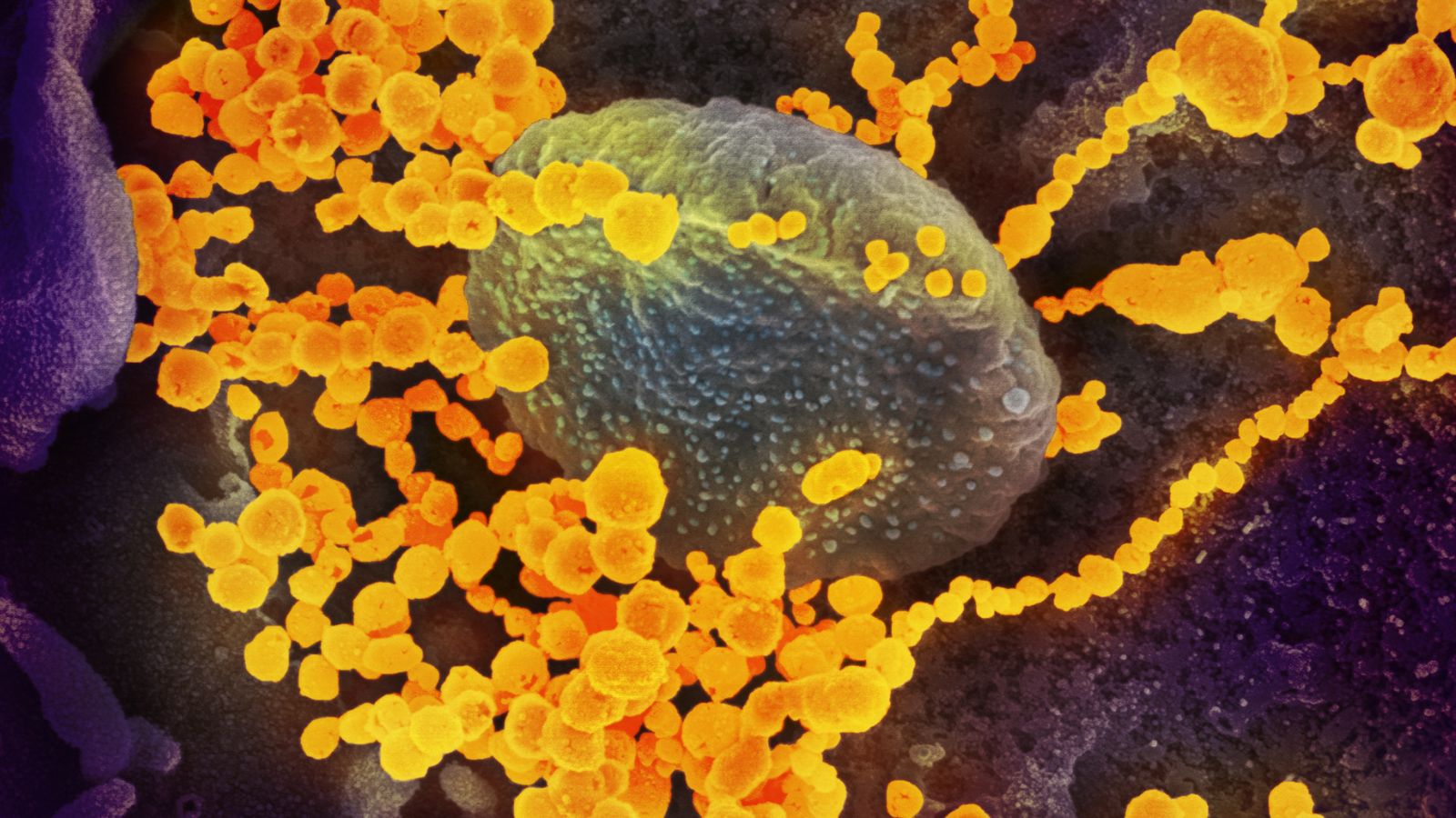  Color photo of an extreme close-up of a virus that looks like a greyish-green ovoid, surrounded by chains of bright orange globules, all in a dark purple environment.